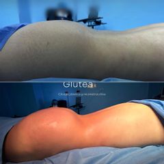 LIPOINYECCION GLUTEA -IDÉALISTE