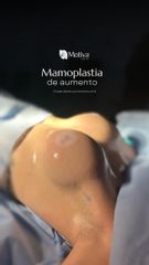 MAMOPLASTIA DE AUMENTO