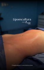 LIPOESCULTURA CON TECNOLOGIA VASER -IDÉALISTE