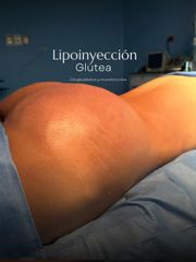 LIPOINYECCION GLUTEA -IDÉALISTE