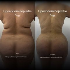 LIPOESCULTURA+ABDOMINOPLASTIA - IDÉALISTE
