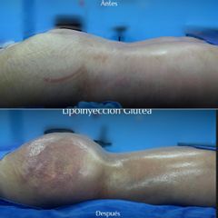 LIPOINYECCIÓN GLUTEA -IDÉALISTE