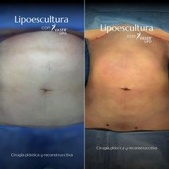 LIPOSUCCION VASER