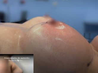 Mamoplastia de aumento antes y después - 874217