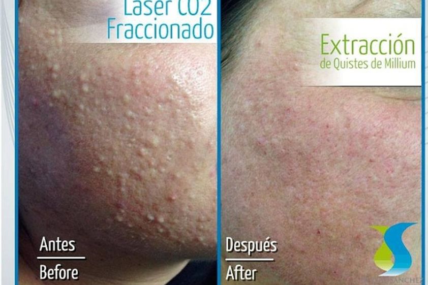 Acné antes y después - 598935