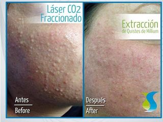 Antes y despues de tratamiento contra el acne