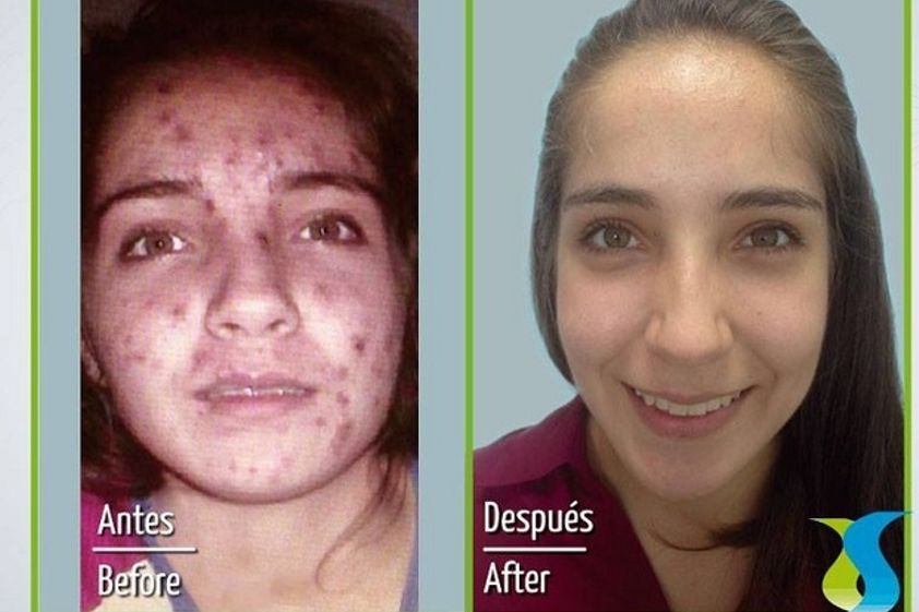 Acné antes y después - 598950