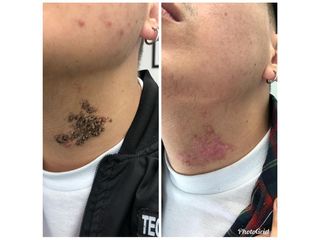 Verrugas - Dr. Sergio Andrés Sánchez Peña