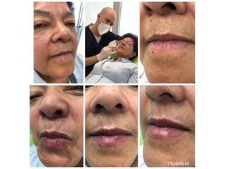Aumento de labios - Dr. Sergio Andrés Sánchez Peña