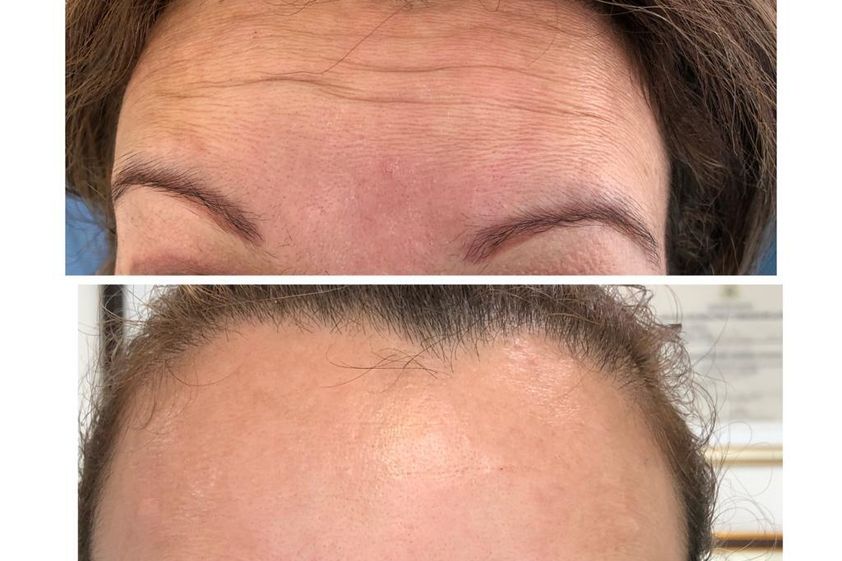 Bótox antes y después - 811420