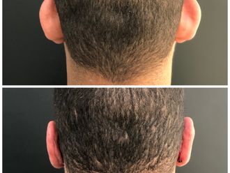 Otoplastia - 647000