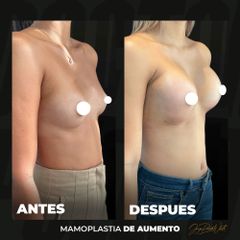 Mamoplastia de aumento - Dr. Jorge Puello White