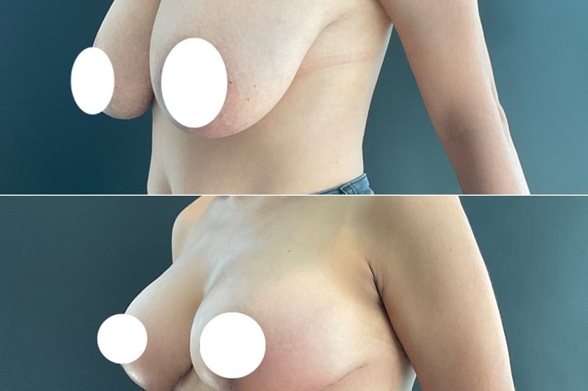Mamoplastia de reducción antes y después - 866298