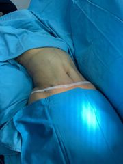 Abdominoplastia - Dr. Jorge Puello White