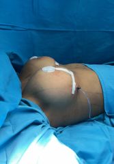 Mastopexia sin implantes - Dr. Jorge Puello White