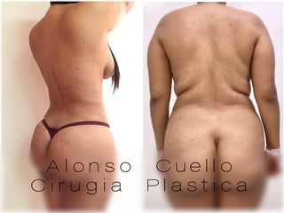 LIPOESCULTURA  TECNICA DE MOLDEAMINETO NATURAL DR . A / C