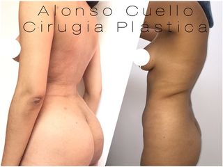 GLUTEOPLASTIA CON TEJIDO GRASO. TECNICA DR. A / C