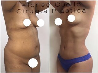 LIPOSUCCIÓN   TECNICA VIBRASONICA DR. A / C