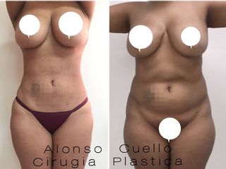 LIPOLISIS, TECNICA VIBRASONICA. DR. A / C