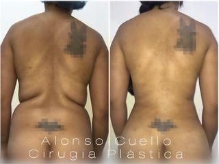 DEFINICIÓN NATURAL DE ESPALDA FEMENINA, TECNICA DR A / C