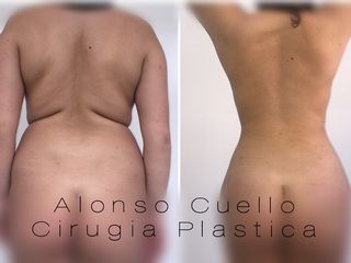 ULTRA DEFINICIÓN DE ESPALDA FEMENINA, TECNICA DR. A / C