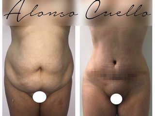 ABDOMINOPLASTIA, UMBILICOPLASTIA NATURAL. TECNICA DR A / C