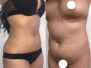 lipolisis laser