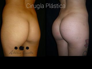 GLUTEOPLASTIA : INJERTO GRASO Y PROTESIS