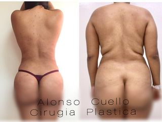 LIPOSUCIÓN Y MODELAMIENTO GLUTEO