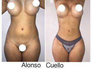 LIPOSUCCIÓN