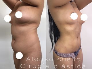 LIPOESCULTURA VASER Y VIBRASONICA, TECNICA PERSONAL