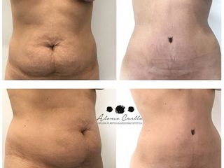 Antes y depsues de abdominoplastia y liposuccion