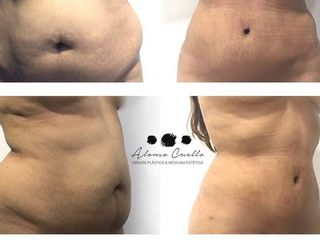 Antes y despues de abdominoplastia