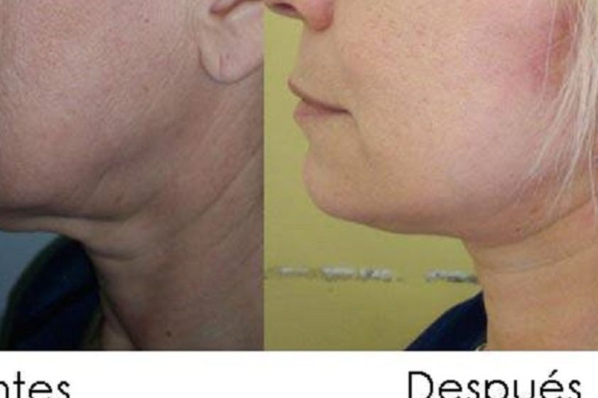 Hilos tensores antes y después - 606899