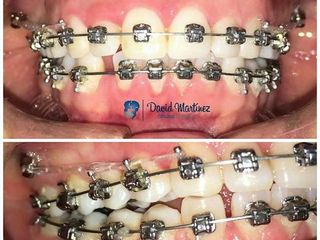 Mini-implantes en Ortodoncia