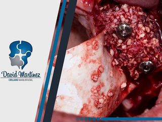 Regeneración Ósea e Implantes Dentales