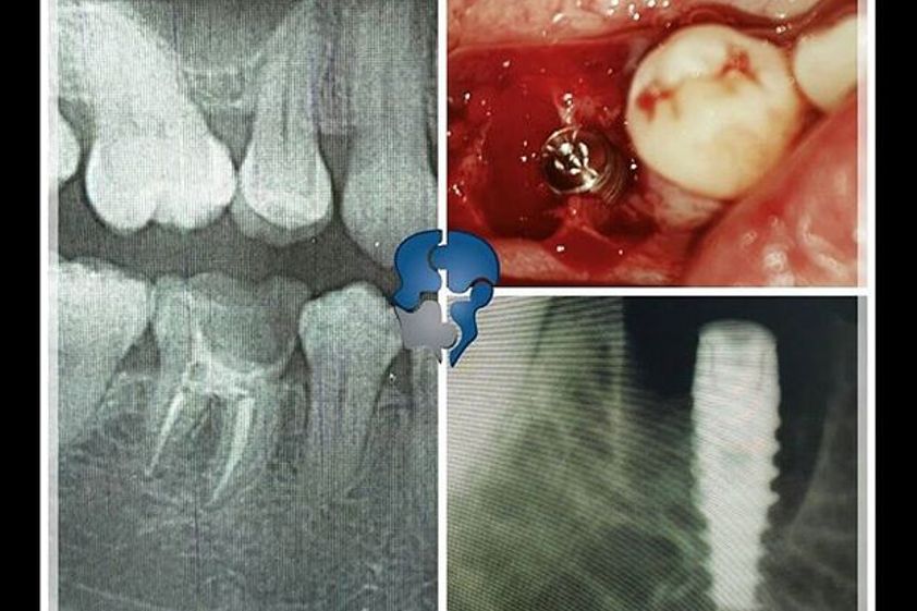 Implantes dentales antes y después - 582401