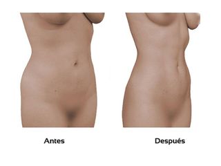 Liposucción