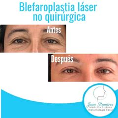 Blefaroplastia - Dr. Juan Ramírez
