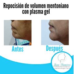 Rellenos faciales - Dr. Juan Ramírez
