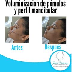 Rellenos faciales - Dr. Juan Ramírez