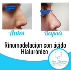 Rinomodelación - Dr. Juan Ramírez