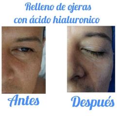 Eliminación de ojeras - Dr. Juan Ramírez