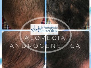 ALOPECIA