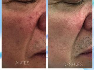 AYD ROSACEA.