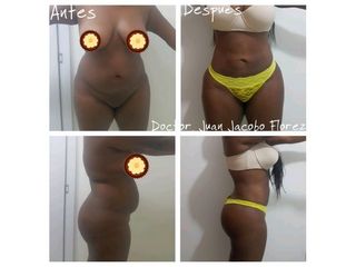 Lipoescultura