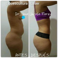Lipoescultura - Dr. Juan Jacobo Florez