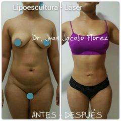 Lipoescultura - Dr. Juan Jacobo Florez