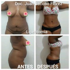 Lipectomía - Dr. Juan Jacobo Florez