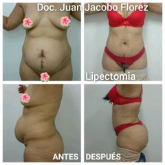 Lipectomía - Dr. Juan Jacobo Florez